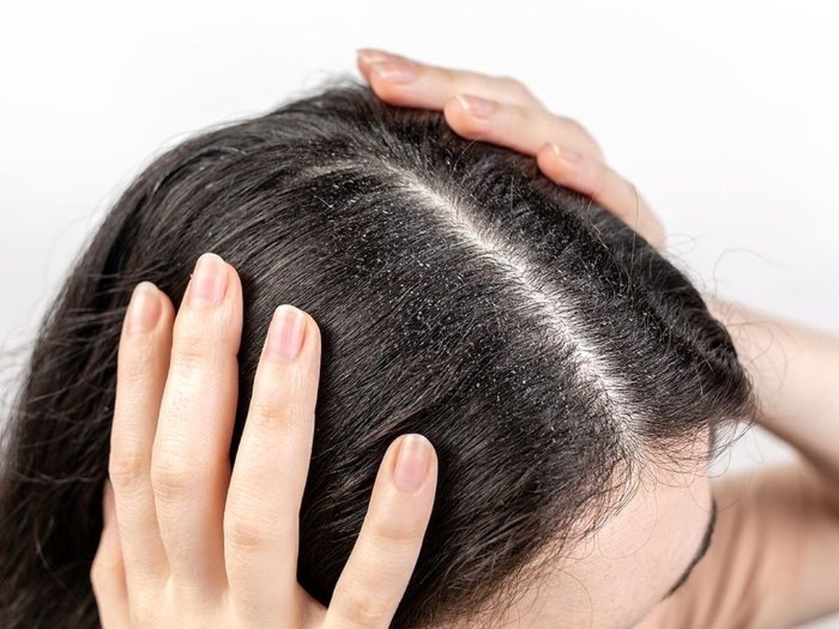 آیا دستکاری کردن مو هم سبب ایجاد شوره سر میشود؟