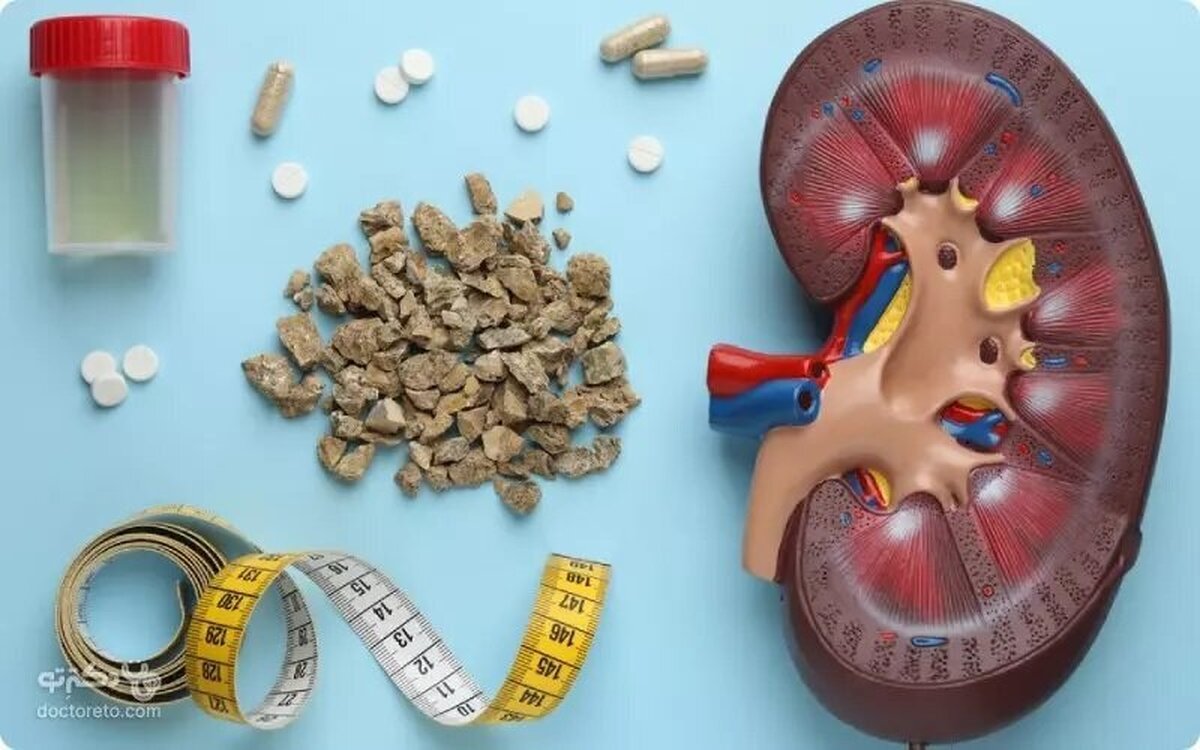 مصرف مشروبات الکلی تاثیری در روند بهبود سنگ کلیه دارد؟