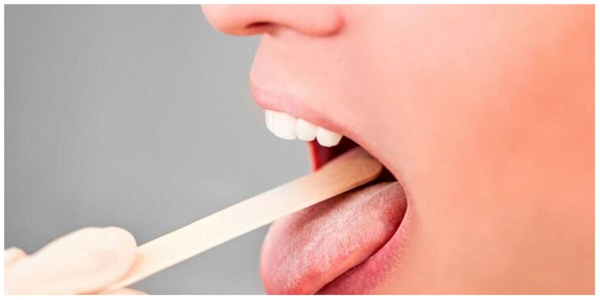 تشخیص انواع بیماری‌ها با بررسی زبان  رد دندان روی زبان نشانه چیست؟
