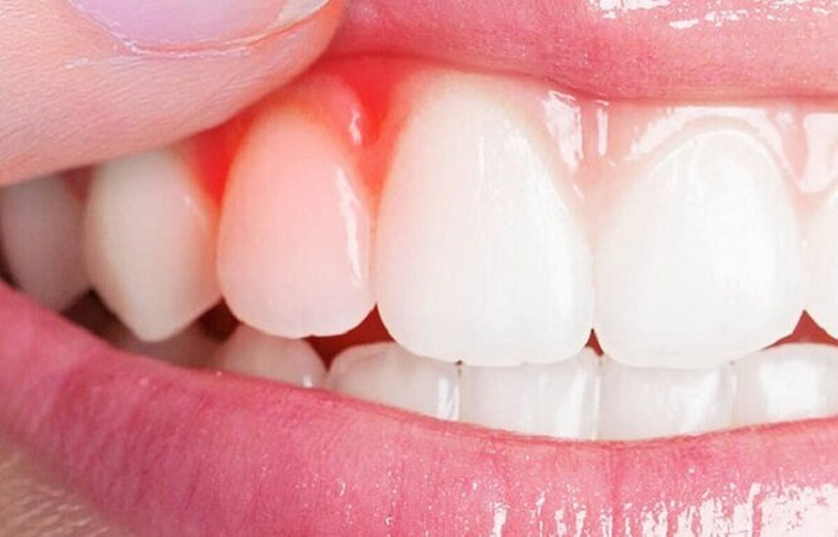 کیفیت خواب ضعیف، رهاورد بیماری‌های لثه