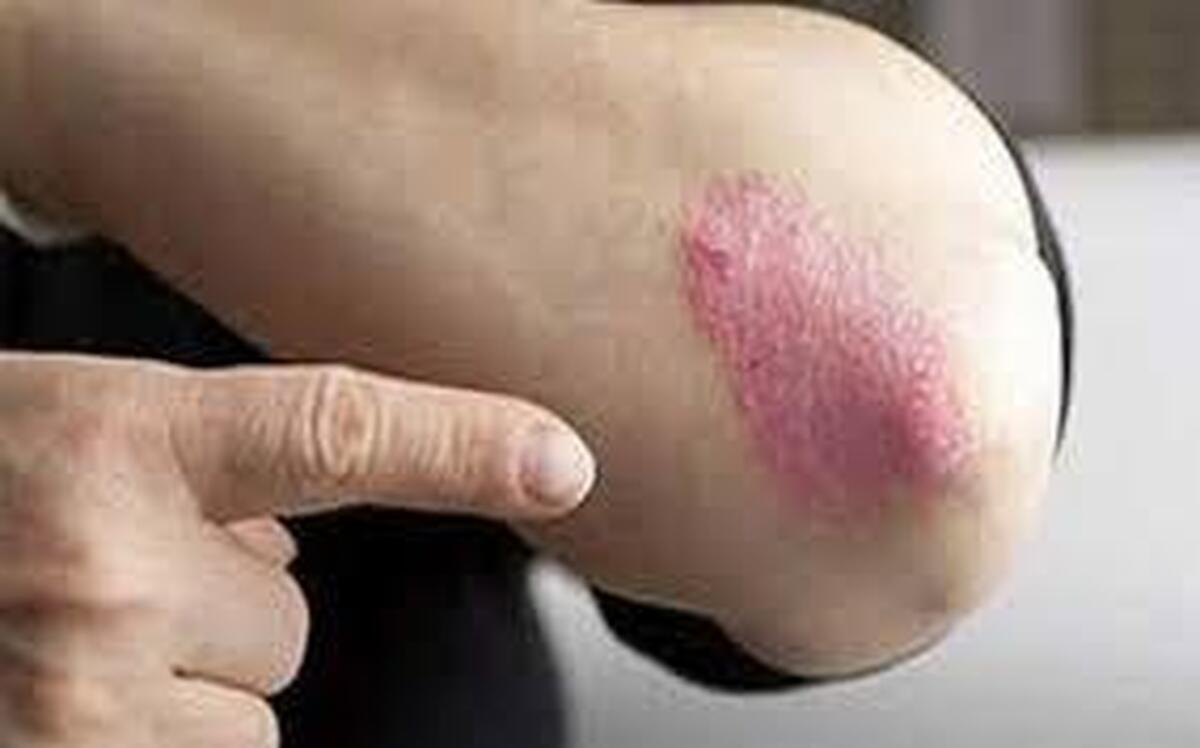 کاهش ۳۰ درصدی خطر پسوریازیس با یک عادت ساده در سبک زندگی